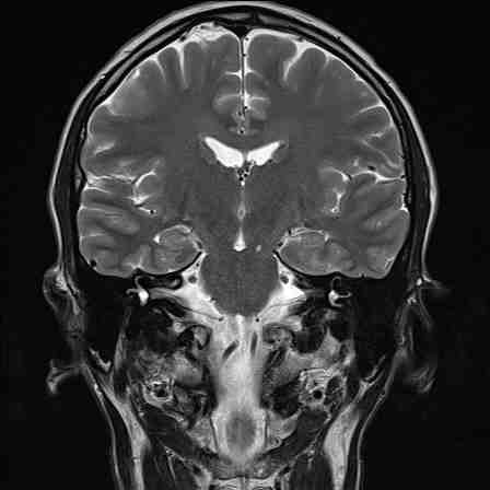 MRI